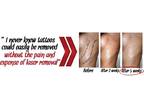 100% Organic Painless Tattoo Removal!