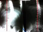 Choose Non-surgical Scoliosis Treatment in the USA